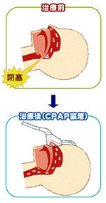 睡眠時無呼吸症候群