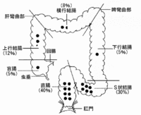 大腸がん